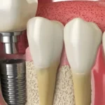 Reasons To Consider Dental Implants Early