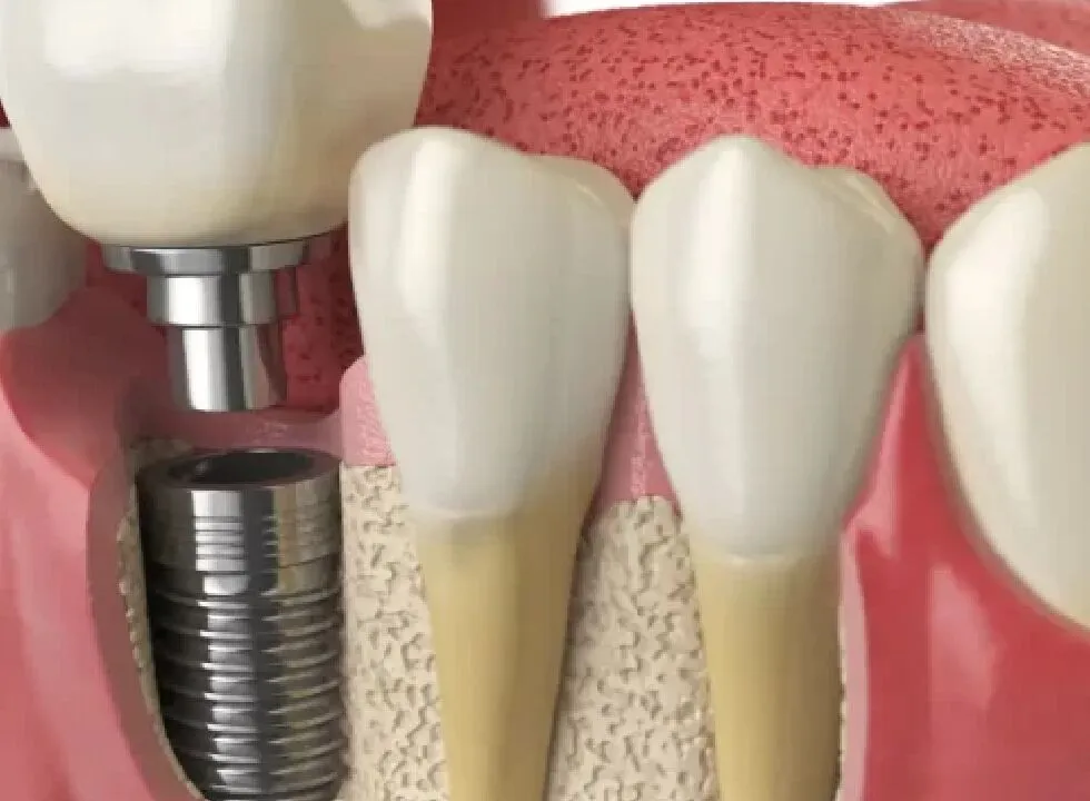 Reasons To Consider Dental Implants Early